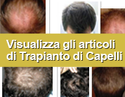 Vai alla sezione Trapianto di Capelli