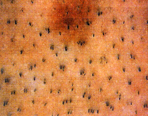 Naturale distribuzione dei bulbi in unità follicolari. Naturale distribuzione dei bulbi in unità follicolari.