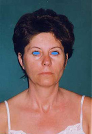 Chirurgia Estetica - lifting viso foto prima dopo.