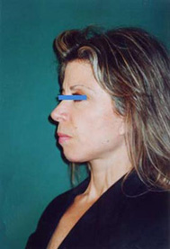 Chirurgia Estetica - lifting viso foto prima dopo.