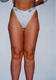Chirurgia Estetica - liposcultura gambe -  foto prima dopo.
