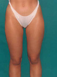 Chirurgia Estetica - liposcultura gambe -  foto prima dopo.