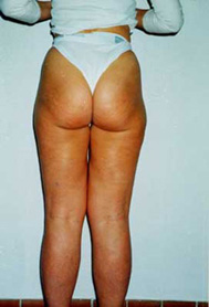 Chirurgia Estetica - liposcultura gambe -  foto prima dopo.