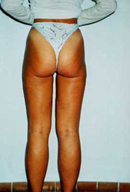 Chirurgia Estetica - liposcultura gambe -  foto prima dopo.