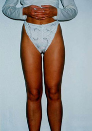 Chirurgia Estetica - liposcultura gambe -  foto prima dopo.