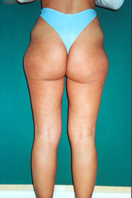 Chirurgia Estetica - liposcultura gambe -  foto prima dopo.