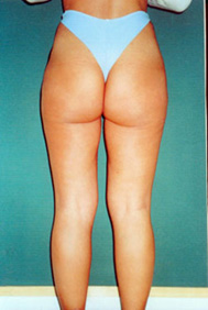 Chirurgia Estetica - liposcultura gambe -  foto prima dopo.
