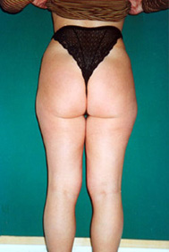 Chirurgia Estetica - liposcultura gambe -  foto prima dopo.