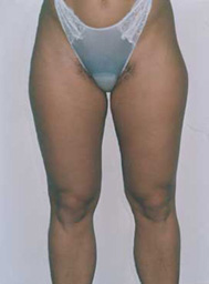 Chirurgia Estetica - liposcultura gambe -  foto prima dopo.
