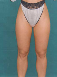 Chirurgia Estetica - liposcultura gambe -  foto prima dopo.