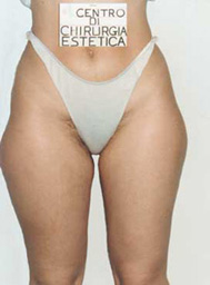 Chirurgia Estetica - liposcultura gambe -  foto prima dopo.