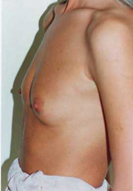 Chirurgia Estetica - Mastoplastica Additiva - foto prima dopo.