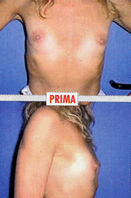Chirurgia Estetica - Mastoplastica Additiva - foto prima dopo.