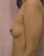 Chirurgia Estetica - Mastoplastica Additiva - foto prima dopo.