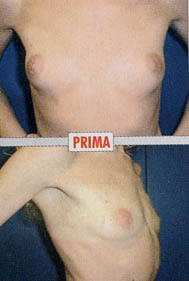 Chirurgia Estetica - Mastoplastica Additiva - foto prima dopo.