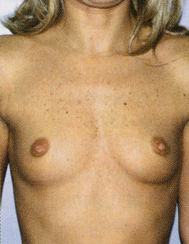 Chirurgia Estetica - Mastoplastica Additiva - foto prima dopo.