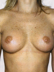 Chirurgia Estetica - Mastoplastica Additiva - foto prima dopo.