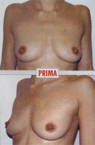 Chirurgia Estetica - Mastoplastica Additiva - foto prima dopo.