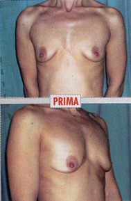 Chirurgia Estetica - Mastoplastica Additiva - foto prima dopo.