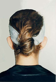 Chirurgia Estetica - Otoplastica - foto prima dopo.