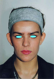 Chirurgia Estetica - Otoplastica - foto prima dopo.