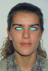 Chirurgia Estetica - Otoplastica - foto prima dopo.
