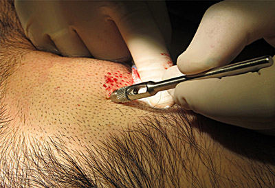 Trapianto ectopico dei capelli Trapianto ectopico dei capelli