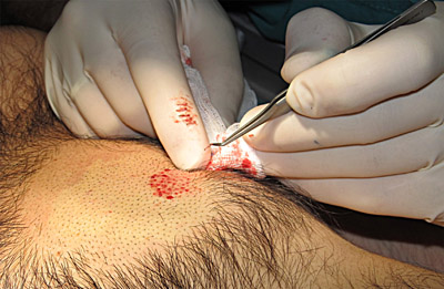 Trapianto ectopico dei capelli Trapianto ectopico dei capelli