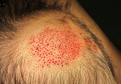 Trapianto ectopico dei capelli Trapianto ectopico dei capelli