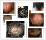 Trapianto di Capelli - Foto Prima -Dopo