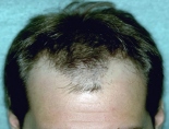 Trapianto di capelli - Foto Prima Dopo.
