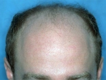 Trapianto di capelli - Foto Prima Dopo.