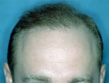 Trapianto di capelli - Foto Prima Dopo.