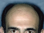 Trapianto di capelli - Foto Prima Dopo.