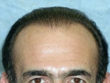 Trapianto di capelli - Foto Prima Dopo.