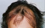 Trapianto di capelli - Foto Prima Dopo.