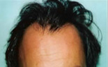 Trapianto di capelli - Foto Prima Dopo.