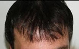 Trapianto di capelli - Foto Prima Dopo.