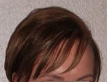 Trapianto di capelli - Foto Prima Dopo.