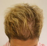 Trapianto di capelli - Foto Prima Dopo.