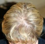 Trapianto di capelli - Foto Prima Dopo.