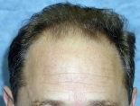 Trapianto di capelli - Foto Prima Dopo.