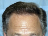 Trapianto di capelli - Foto Prima Dopo.