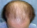 Trapianto di capelli - Foto Prima Dopo.