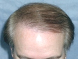 Trapianto di capelli - Foto Prima Dopo.