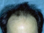 Trapianto di capelli - Foto Prima Dopo.