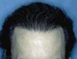Trapianto di capelli - Foto Prima Dopo.
